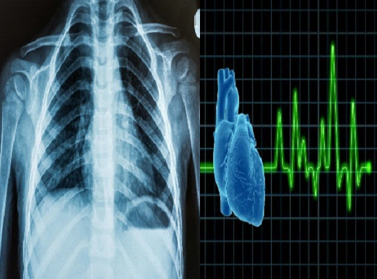 X-Ray and ECG